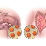 magen modificada de: https://vistoenlaweb.org/2013/07/19/10-cosas- que-debes-saber-sobre-el-virus-del-papiloma-humano-vph/