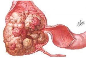 cancer de colon no poliposico