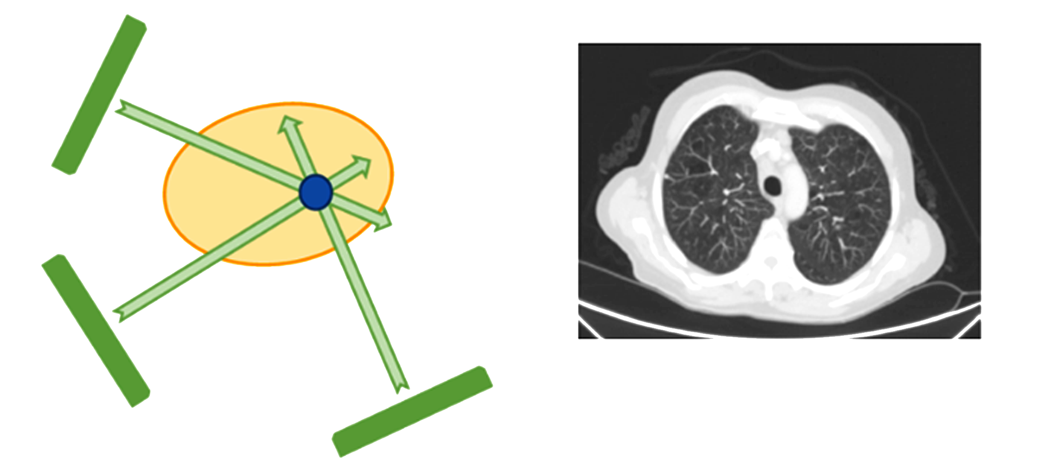  Tomografía de Rayos X: Se mide la densidad de cada parte iluminándola con rayos X por distintas trayectorias (lado izquierdo). Repitiendo el procedimiento en diferentes áreas se obtiene la imagen tomográfica del órgano (lado derecho).