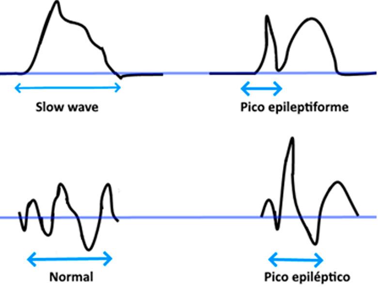 Figura 1: Algunos tipos ondas presentes en los EEG [4].